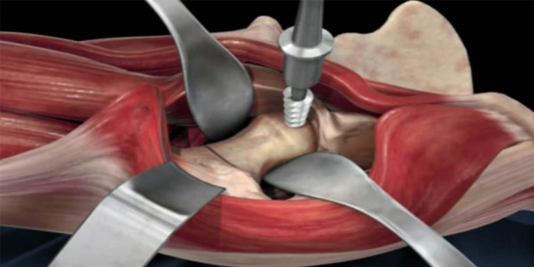 total-hip-replacement-anterior-approach-florida-orthopaedic-institute