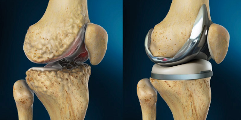 Facts About Total Knee Replacement You Must Know Aditi Corporation